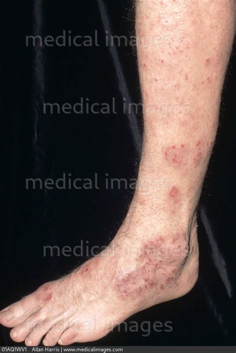Stock Image Dermatology Infected Eczema Patches Of Dry Excoriated Skin