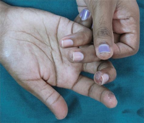 Dyshidrotic Eczema Fingernails Nail Ftempo