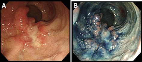 A Rare Cause Of A Rectal Tumor Like Lesion Gastroenterology