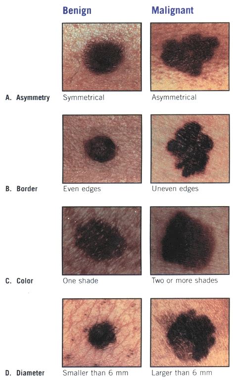 Skin Cancer Melanoma And Tumor Pictures Photos Images Mri Xray X Ray