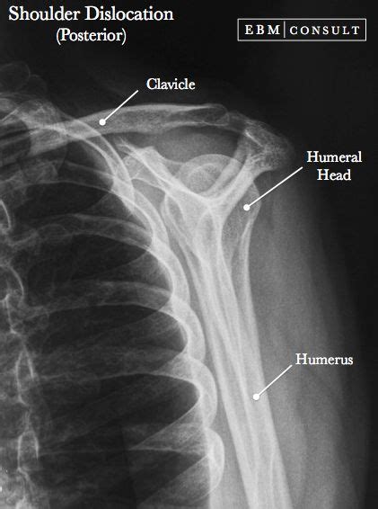 Posterior Shoulder Dislocation X Ray WaylonjoysSteele