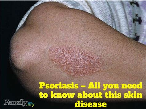 Psoriasis All You Need To Know About This Skin Disease Malaysia