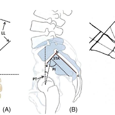 The Schematic Diagram Shows The Radiographic Parameters Of Lumbopelvic