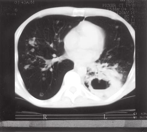 Lateral Chest Radiograph Shows Thick Walled Fluid Containing Cavity In