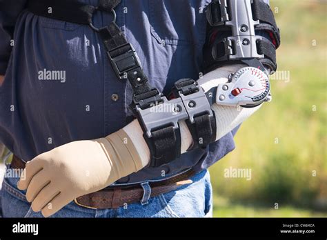 Man With Prosthetic Arm Brace To Aid In Recovery Of A Torn Bicep Stock