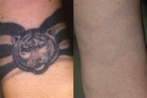 How Painful Is A Tattoo Removal