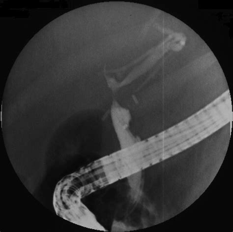 Initial Diagnostic Ercp After Bile Duct Injury Demonstrating A Common