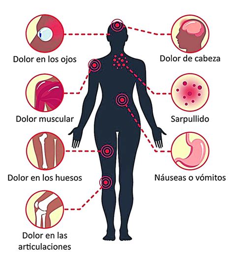 En algunos sitios al dengue se le suele llamar 'fiebre quebrantahuesos' debido a los síntomas que causa esta enfermedad, como la fiebre, el dolor intenso en las articulaciones, atrás de los ojos. Diez mitos y errores sobre la fiebre quebrantahuesos - LA ...
