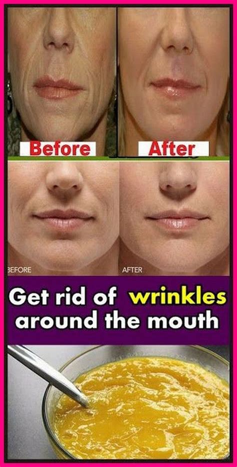 How To Remove Deep Mouth Wrinkles Really Fast Mouth Wrinkles Neck