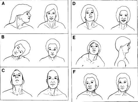Treatment Of Spasmodic Torticollis With Intradural Selective Rhizotomies In Journal Of
