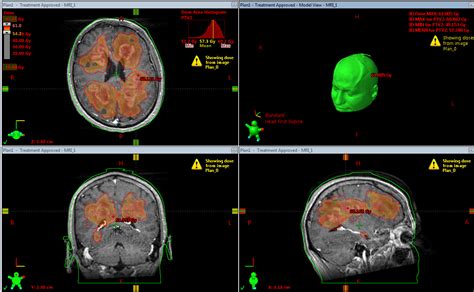 Multifocal Low Grade Astrocytoma Successfully Treated With Volumetric