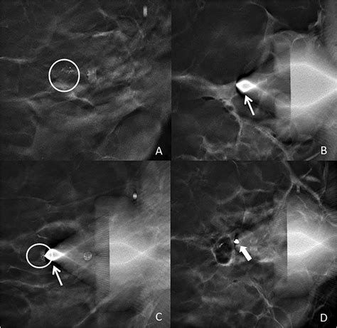 Digital Breast Tomosynthesis Dbt Guided Biopsy Of Calcifications Pearls And Pitfalls