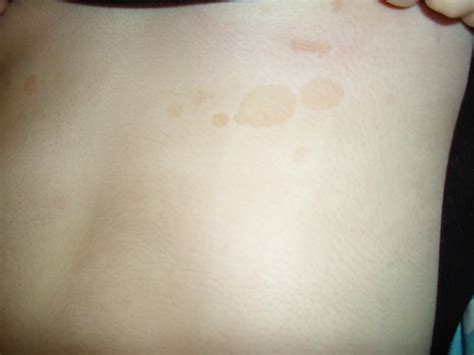 Red Blotchy Skin On Chest Pictures Photos
