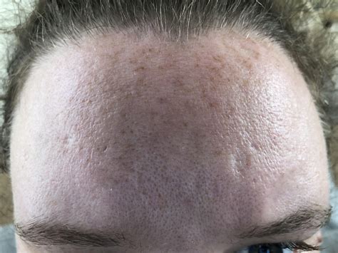 Skin Concerns Help Reducing The Craters On My Forehead R