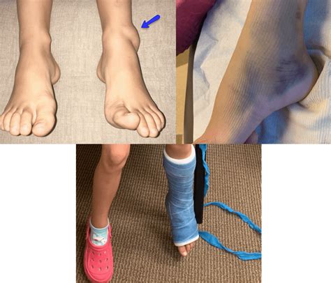 My 5 Yr Old Daughter Severely Sprained Her Ankle And Shifted Her Growth