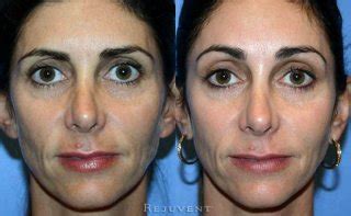 More images for botox brow lift before and after pics » Botox Brow Lift Photos • Rejuvent Medical Spa Scottsdale