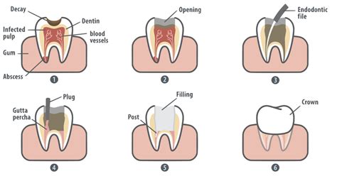 The only way to know for sure if you can benefit from orthodontic treatment despite factors like crowns, root canals, or missing teeth is to contact braces are designed around the teeth needing to be moved, and not to interfere with routine dental care. Root Canal Northborough MA | Painless Root Canal Therapy
