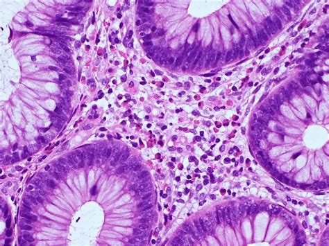 Cureus Eosinophilic Gastroenteritis In The Small Intestine Mimicking