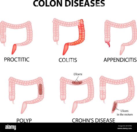 Colon Diseases Proctitis Colitis Appendicitis Polyp Ulcer Crohns