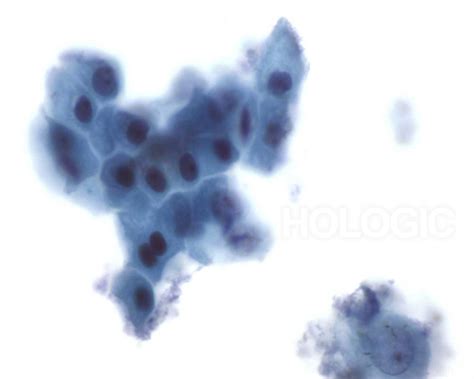 Atypical Metaplastic Cells Respiratory Cytology