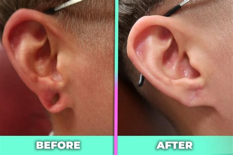 ‪do You Have Torn Or Stretched Earlobes ‬ ‪have Them Repaired At Juva