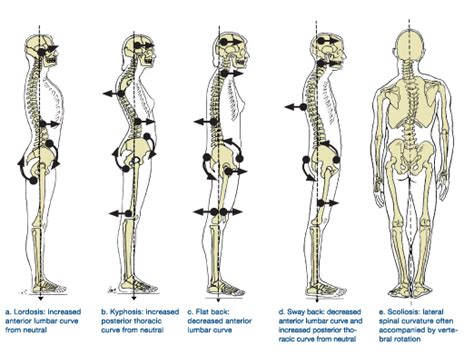 How To Address The Root Cause Of Swayback Posture Exercises Tests