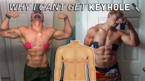 Why I Cant Get Keyhole Ftm Top Surgery Youtube