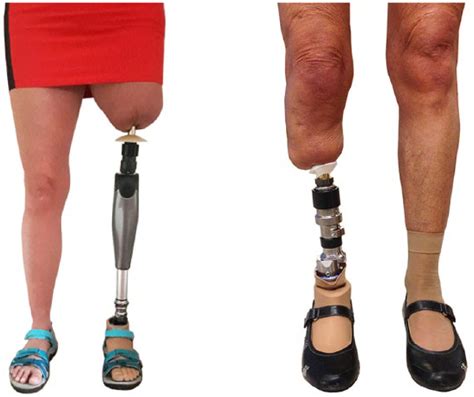 Functional Performance And Safety Of Bone Anchored Prostheses In