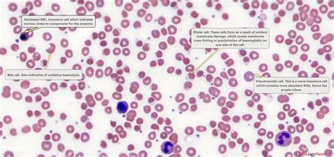 Approach To Haemolysis Learnhaem Haematology Made Simple