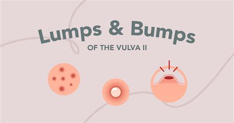 Ferne Health Lumps And Bumps Of The Vulva Part Ii