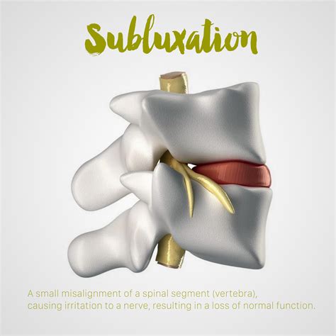 Subluxation A Small Misalignment Of A Spinal Segment Vertebra