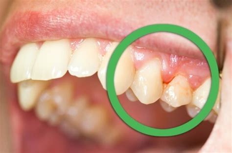 Upala Zubnog Mesa Prirodni Lijekovi Koji Stvarno Djeluju Aurum