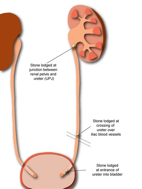 Kidney Stone Passage Passing A Kidney Stone