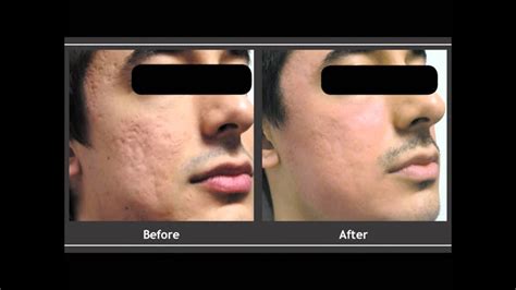 Co2 Laser For Scars Before And After Youtube