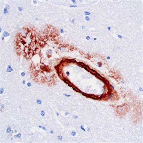 Cerebral Amyloid Angiopathy Congophilic Angiopathy Doccheck