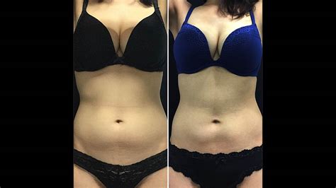 Laser Lipo Before And After All You Need Infos