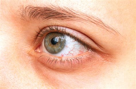 Subconjunctival Hemorrhage Causes And Symptoms Iris