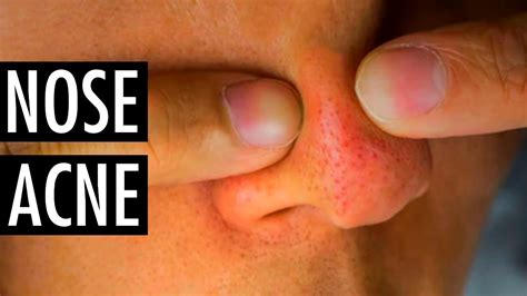 How To Get Rid Of Nose Pimples Remove Pimples On Nose Tiege Hanley Youtube