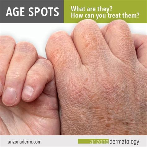 What Are Age Spots How Can You Treat Them Arizona Dermatology