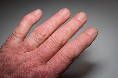 Foto De Mão De Um Closeup Paciente Da Psoríase Artrite Psoriática