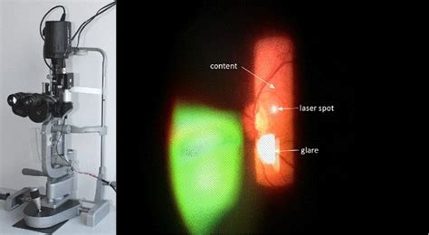 Retinal Slit Lamp Video Mosaicking Springerlink