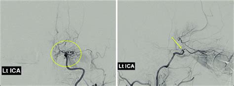 Frontal And Lateral Projections Of Conventional Angiogram Of