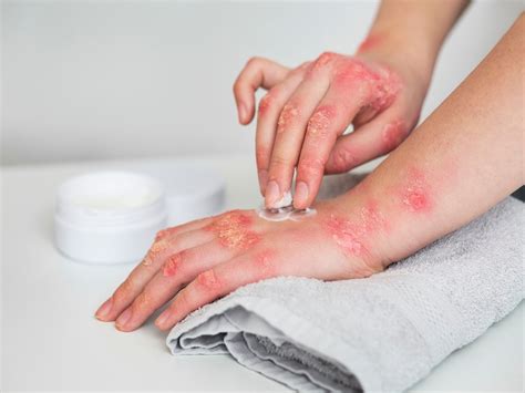 World Psoriasis Day 2022 How To Deal With Psoriasis In Daily Life