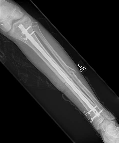 Midshaft Tibial Fracture The Bone School