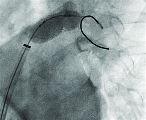 Stenting Of The Left Pulmonary Artery Using A Genesis 29x10 Mm Stent