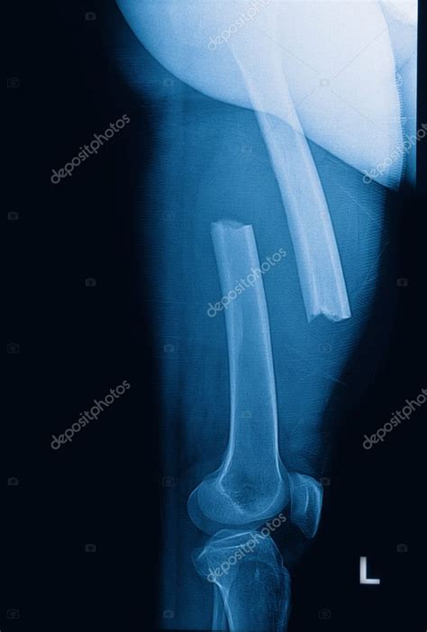 Broken Human Thigh X Rays Image Lelf Leg Fracture — Stock Photo