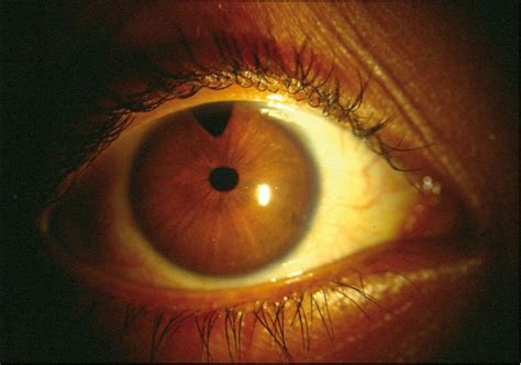 Eye Disease High Pressure Astigmatism Glaucoma Swollen Eyes Disease