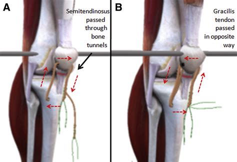 Surgical Treatment For Chronic Rupture Of The Patellar Tendon Performed In Stages
