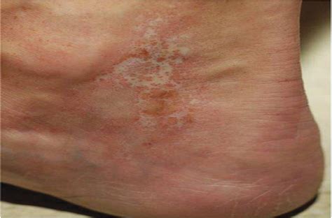 Successful Treatment Of A Scleroderma Associated Leg Ulcer W