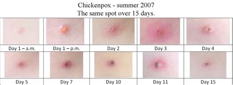 What Is Chickenpox Varicella Health Life Media